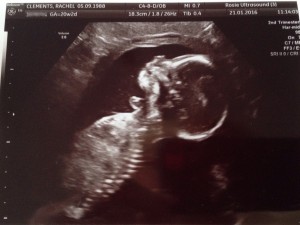 Miss Stomawise 25 weeks pregnant Ileostomy Stoma  Ultrasound